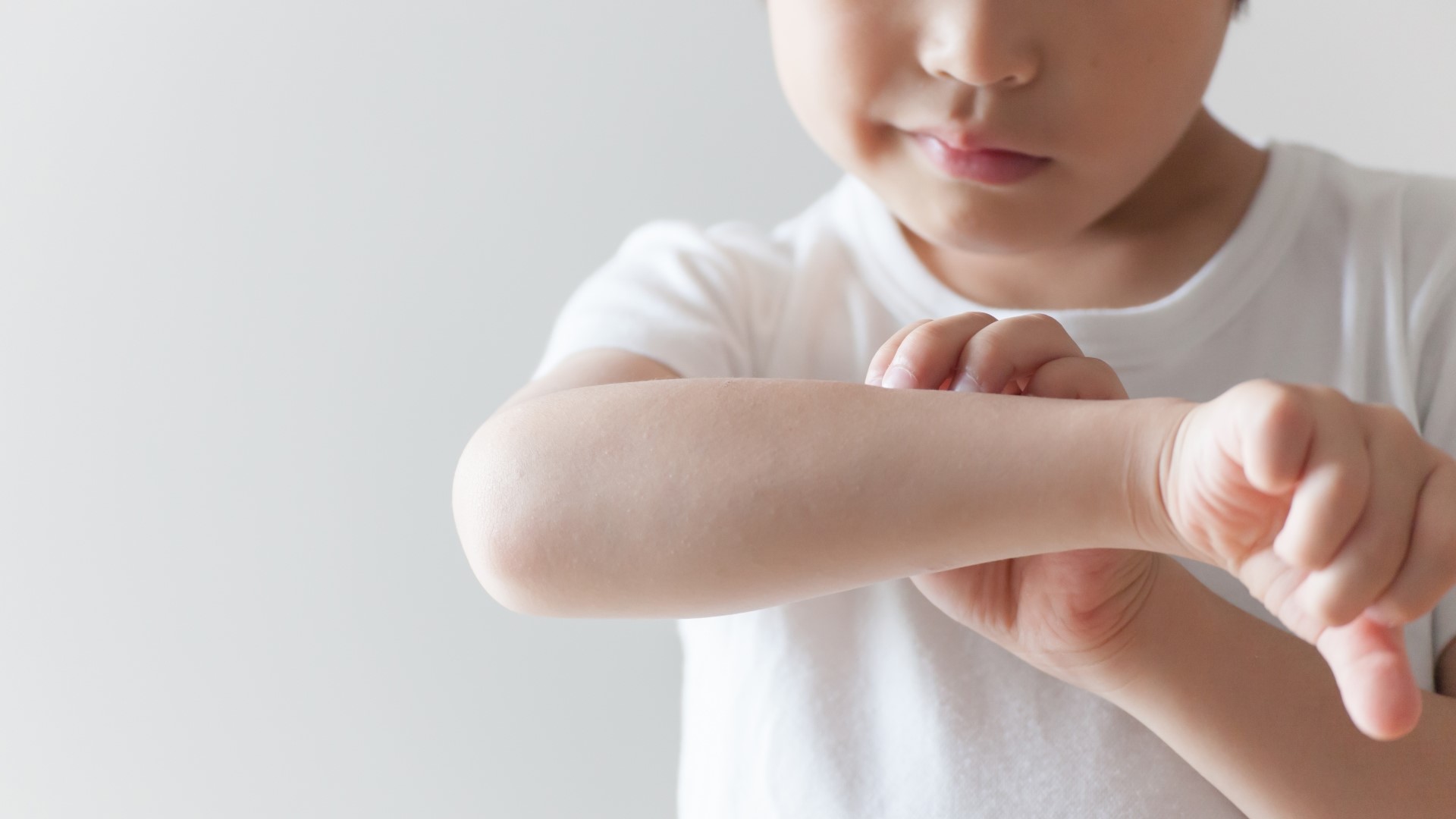 【健康】蕁麻疹的原因、癥狀和紓緩方法