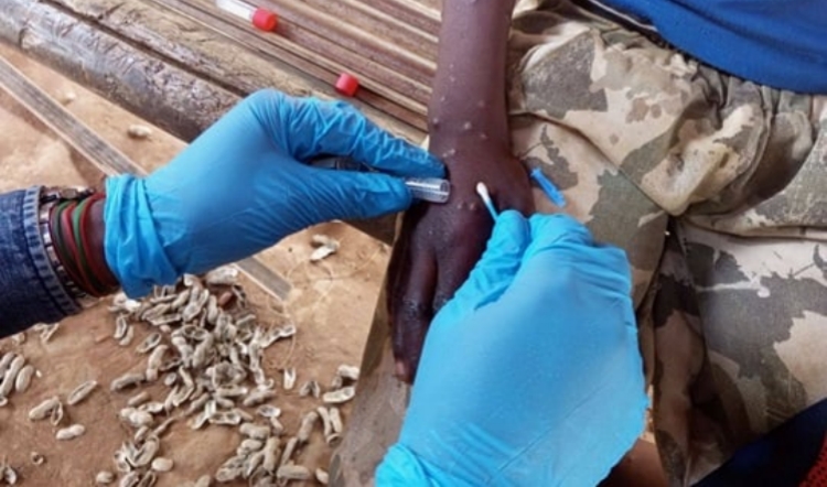 世衛(wèi)組織啟動全球計(jì)劃遏制猴痘疫情傳播