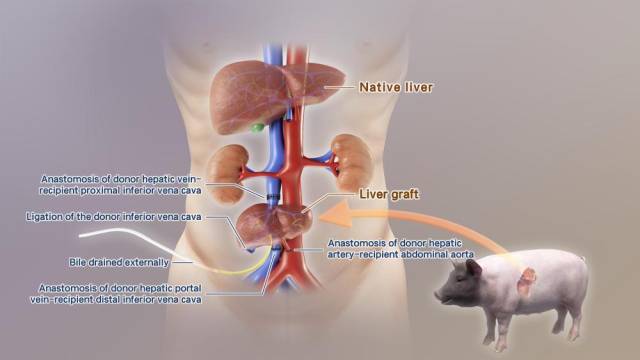 全球首例！中國(guó)團(tuán)隊(duì)成功將基因編輯豬肝臟移植人體